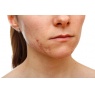 Ansigtsbehandling - Acne be... at C Beauty and Care
