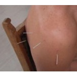 Akupunktur at Græstebæk Akupunktur